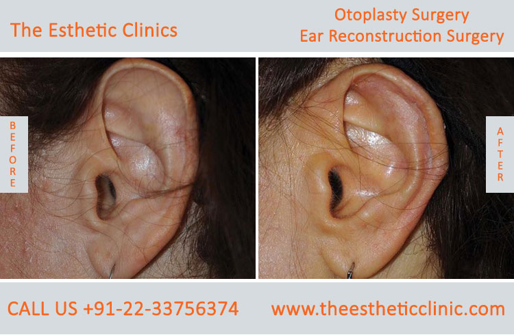 Otoplasty, Ear reconstruction surgery before after photos in mumbai india (3)